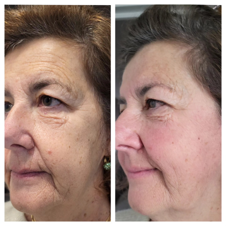 Le Myolift en myofascialogie.